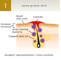 Acne-prone skin