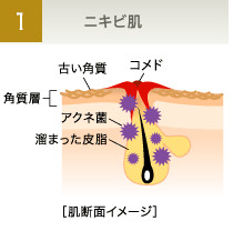 ニキビ肌